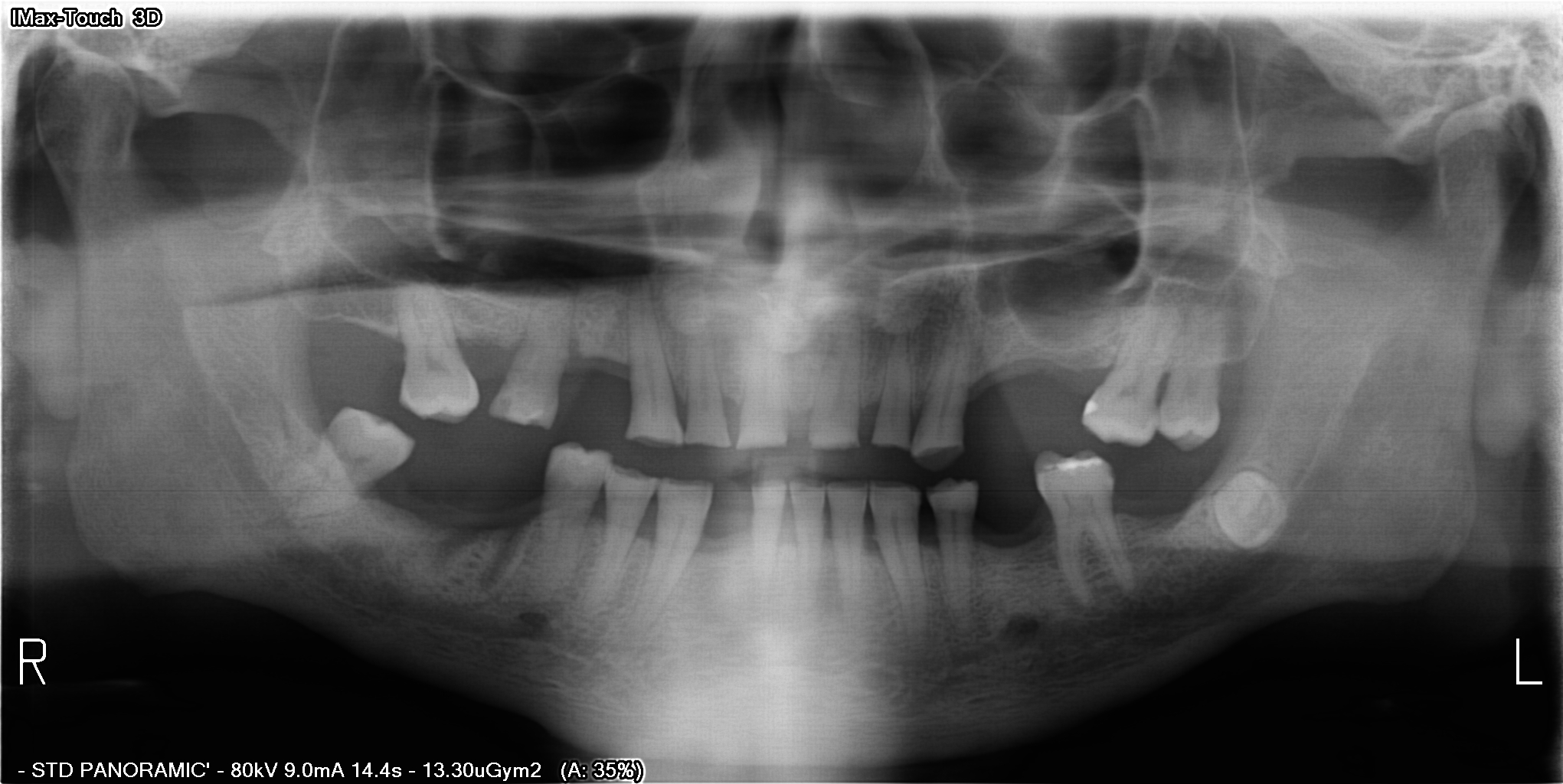 Radiografia panorâmica do acervo público de Fretes López e colaboradores, sem contornos sobrepostos.